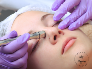 Microdermabrasion Bury Manchester