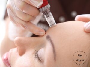 Microneedling Bury Manchester